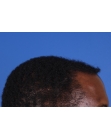 After Hair Transplant&nbsp;Front